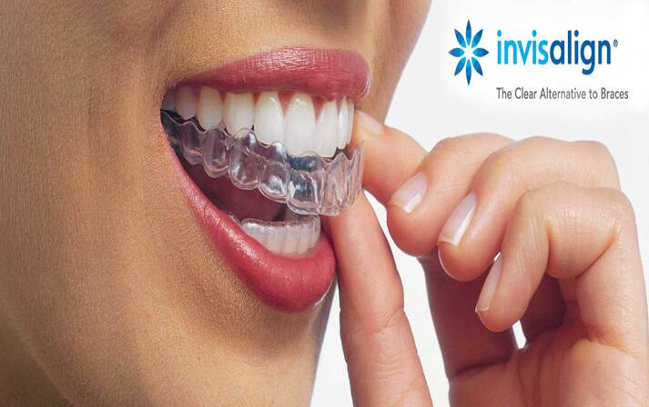 https://drraissouni.ma/wp-content/uploads/2022/04/Invisalign-clearalternative-1-1.jpg